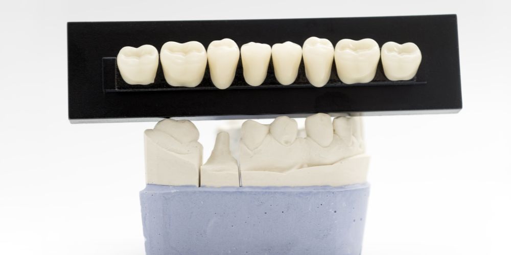 Tooth Crown Cost in Australia: Porcelain vs Ceramic vs Metal Crowns