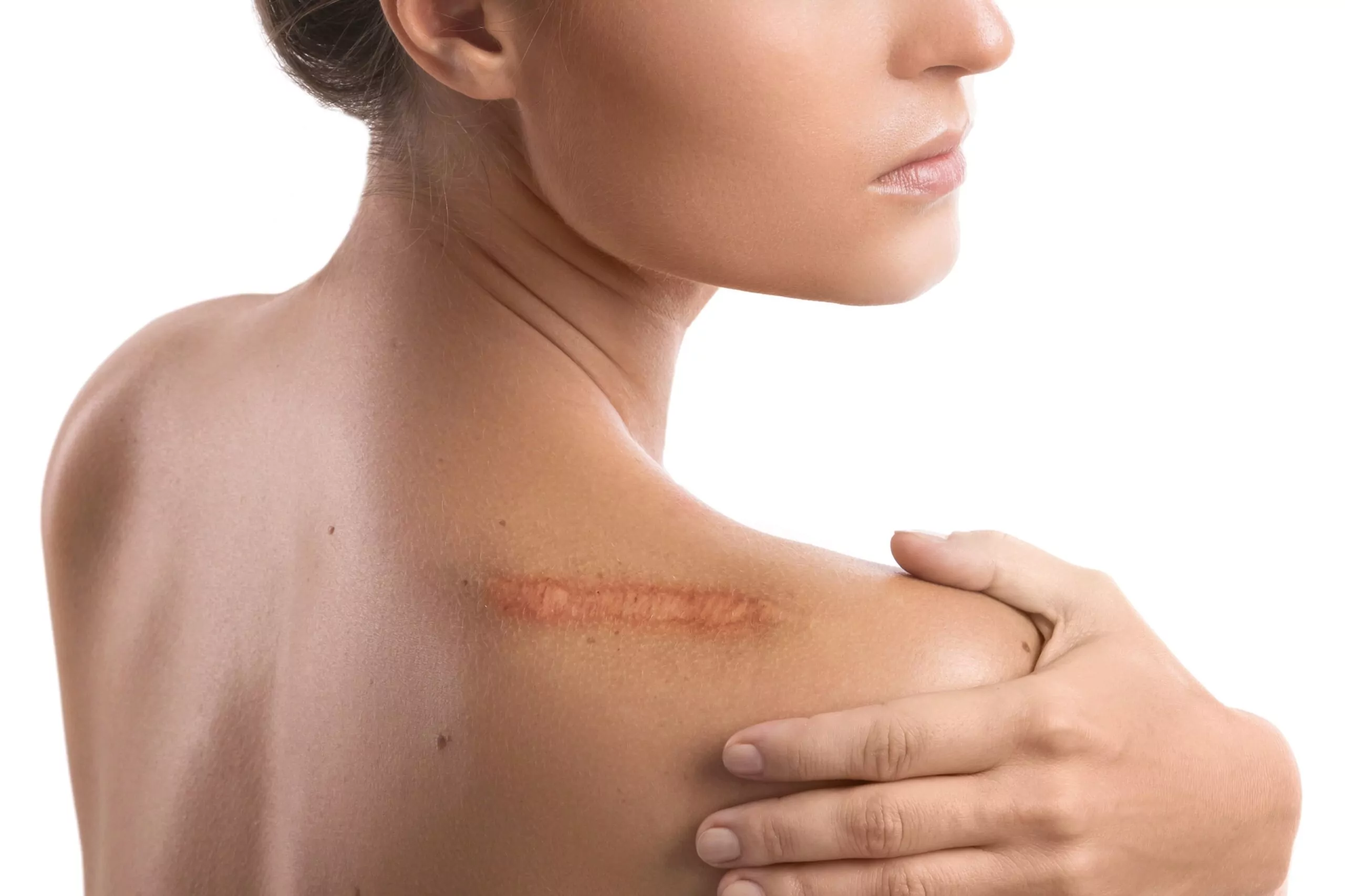 What Are the Risks Involved in Keloid Surgery?