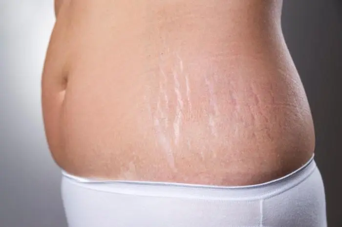 How HIPRO V Rewrites the Story of Stretch Marks