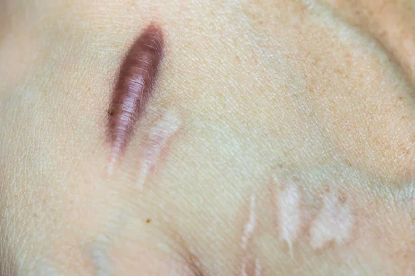 What are the risks involved in keloid surgery?