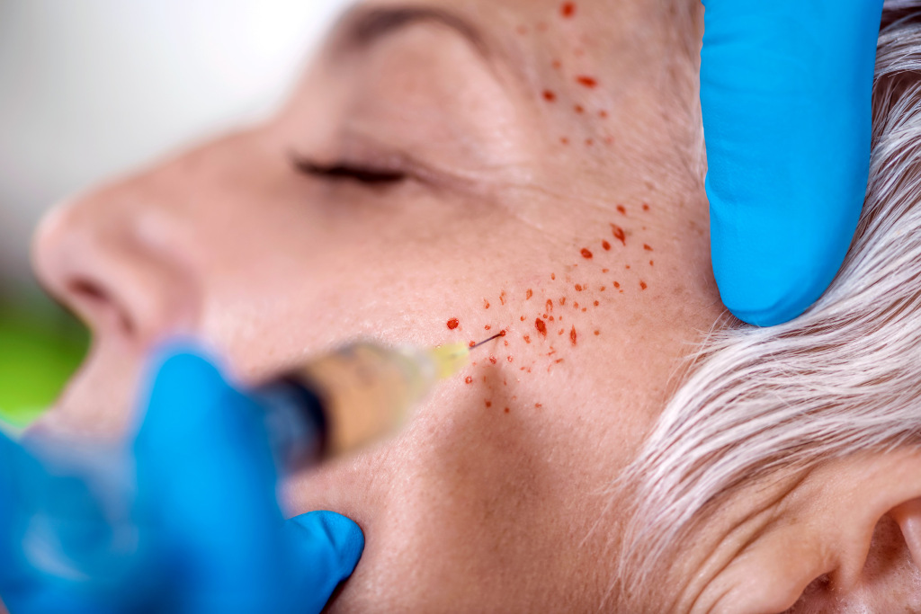 How long does the vampire facelift treatment last?