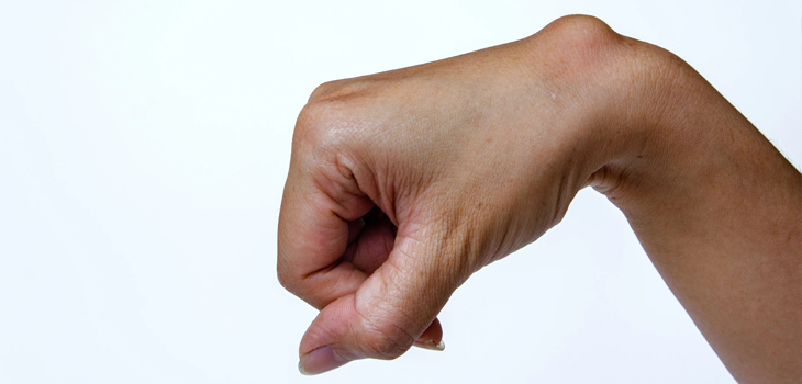 Are Lipomas Something to Be Concerned About?