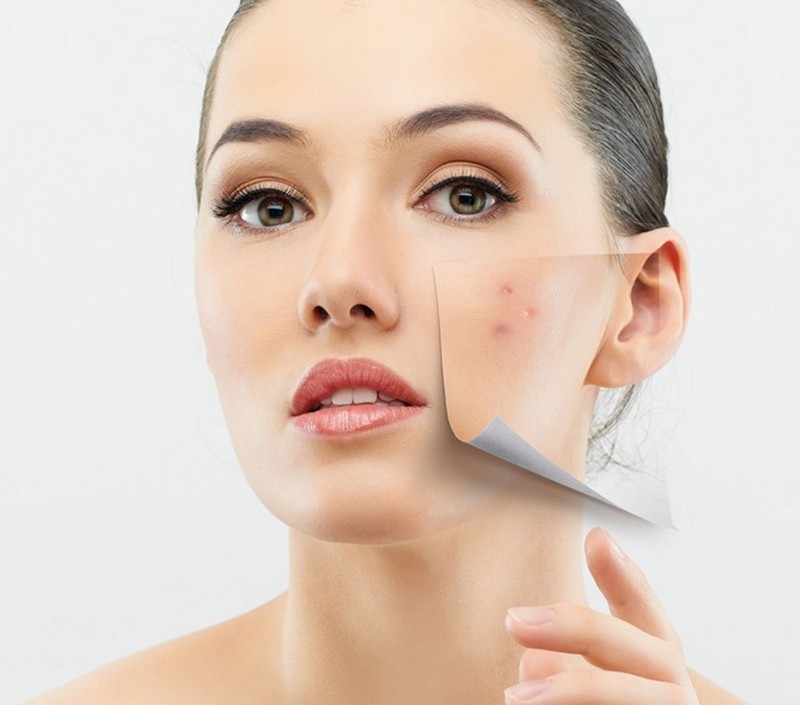 LASER ACNE SCAR REMOVAL: DOES IT WORK? | Dr Sajjas clinic