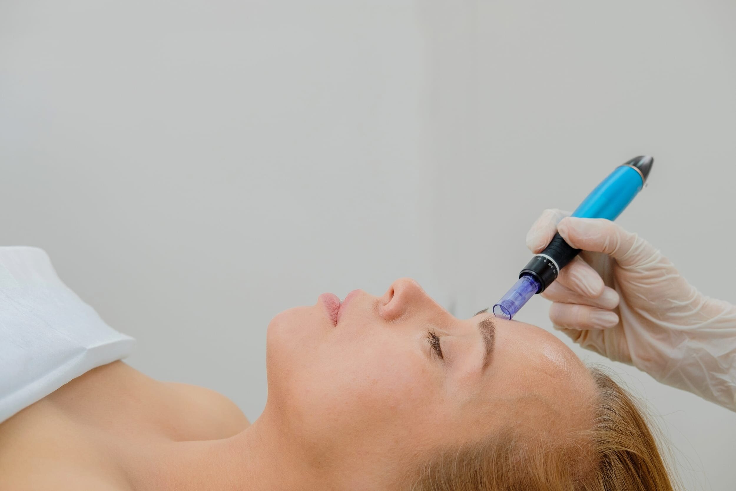 Is Micro Needling Treatment Effective for Pore Reduction?