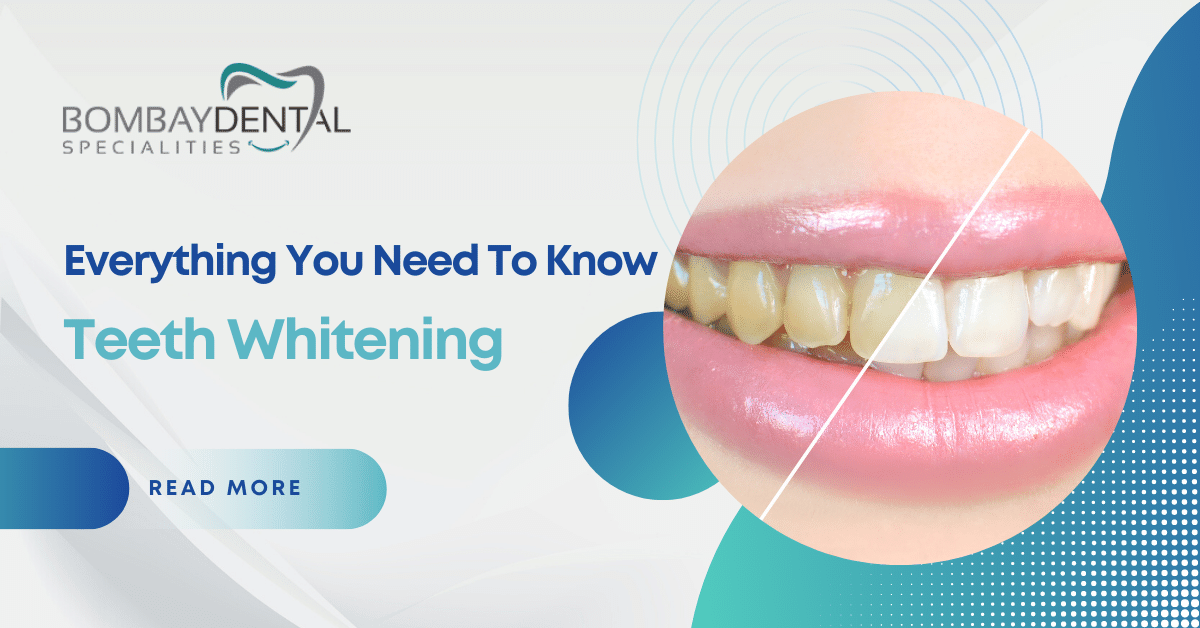 Teeth Whitening: Everything You Need to Know