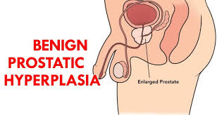 Benign Prostatic Hyperplasia Treatment Market 2022 Major Key Players and Industry Analysis Till 2028
