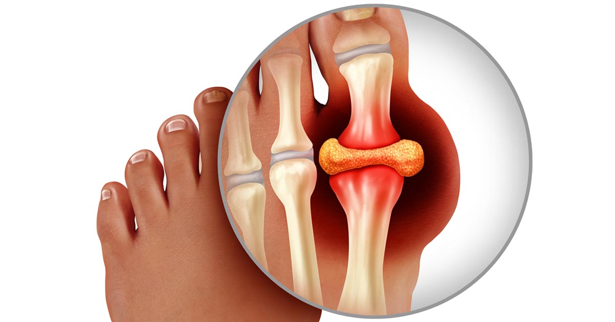 Gout Therapeutics Market Size, Share, Regional Overview and Global Forecast to 2028