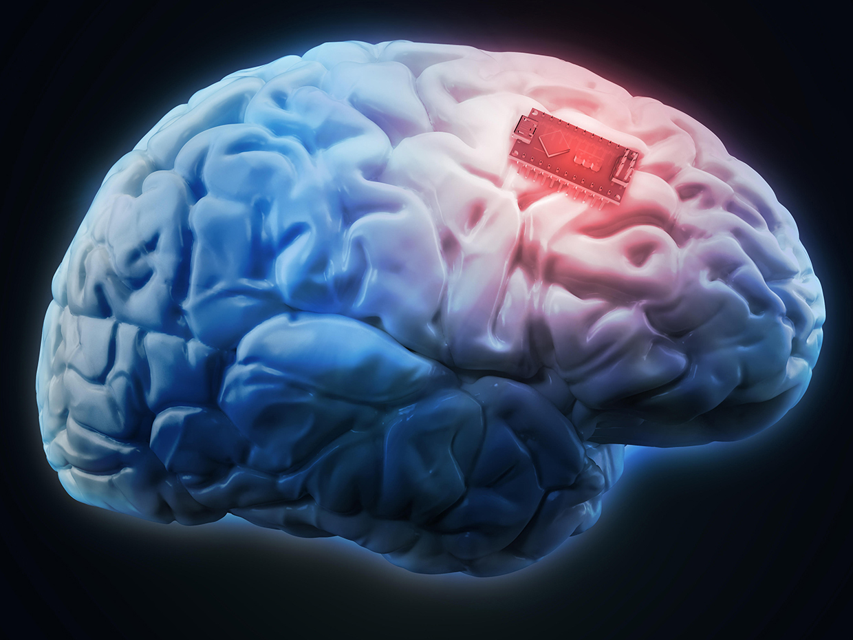 United States Brain Implants Market 2023-2027: Regional Analysis and Forecast | TechSci Research