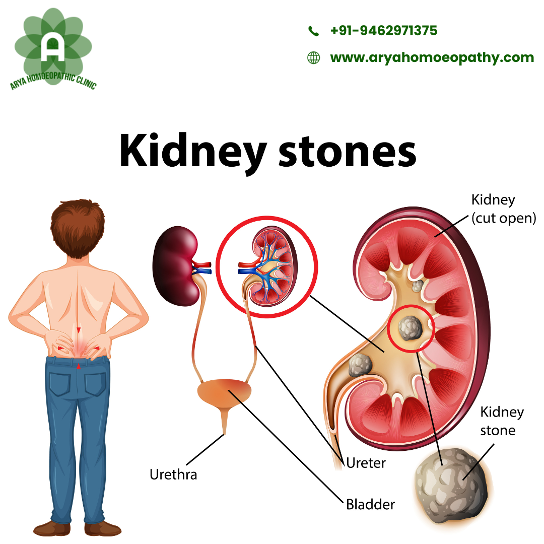The Impact of Kidney Stones on Your Health