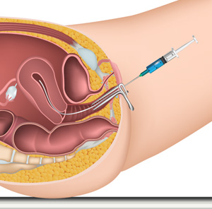 IUI Infertility treatment - 