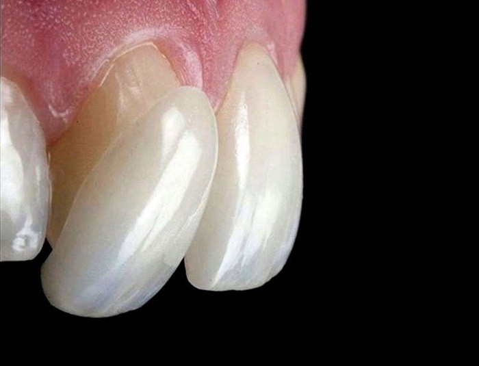 Tips On How To Take Care Of Your Dental Veneers