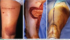 Unlocking Efficiency: The Role of Technology in Soft Tissue Sarcoma Treatment Market
