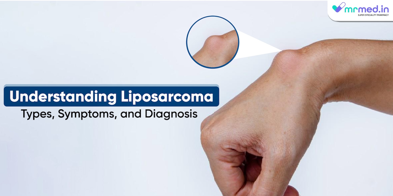 Understanding Liposarcoma: Types, Symptoms, and Diagnosis