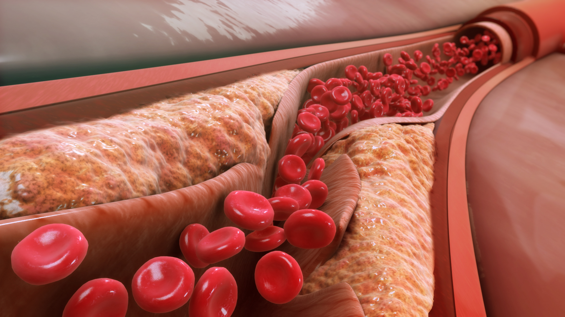 Blood Clots: Risks, Symptoms and Treatments