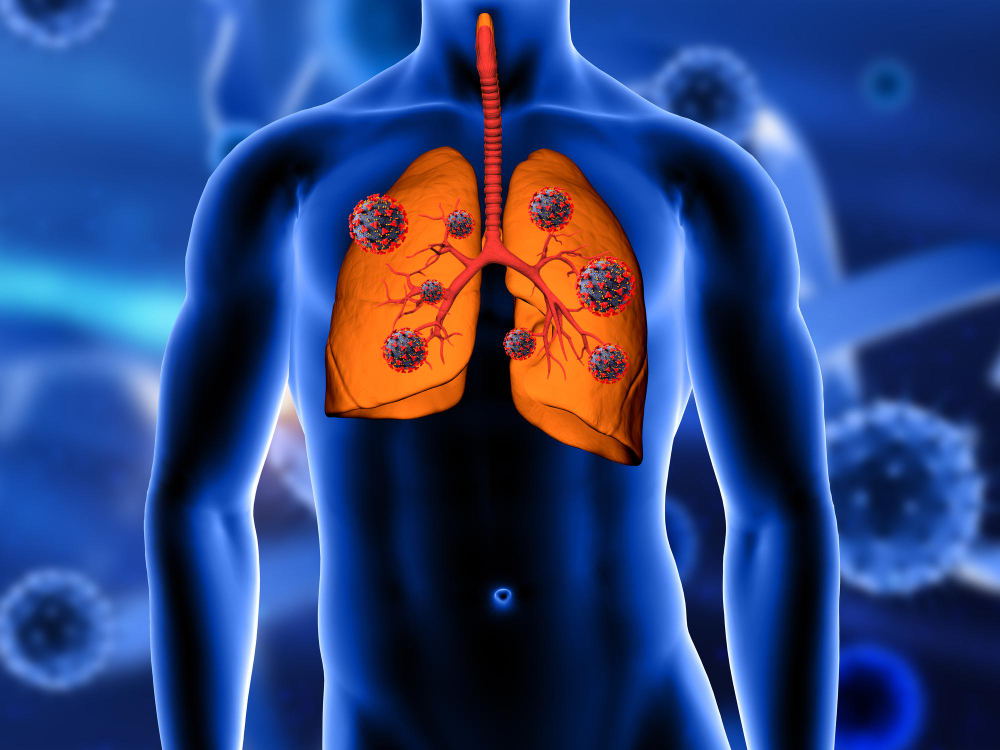 Brief introduction of Non-Small Cell Lung Cancer