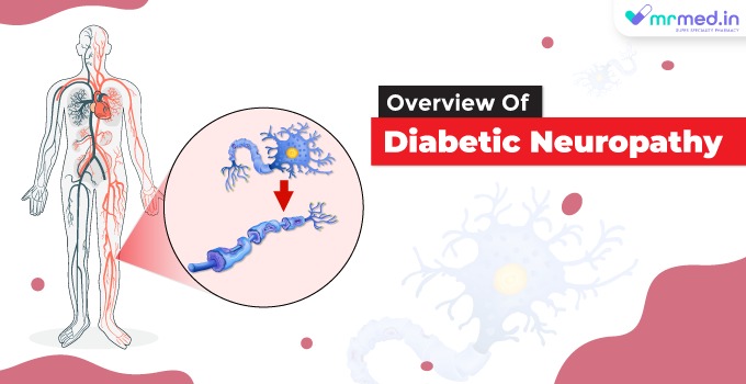 Overview Of Diabetic Neuropathy