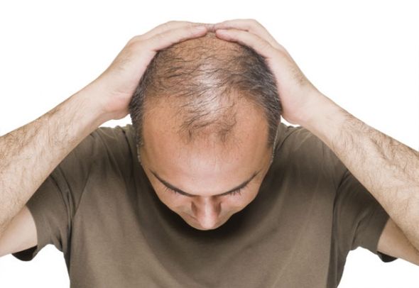 Best Solution For Male Baldness In Dubai