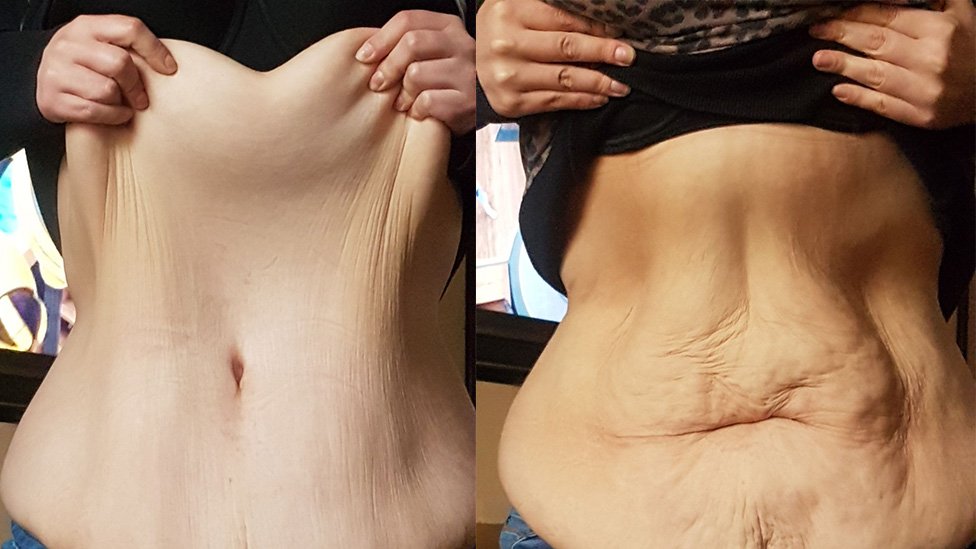 Loose Skin after Weight Loss