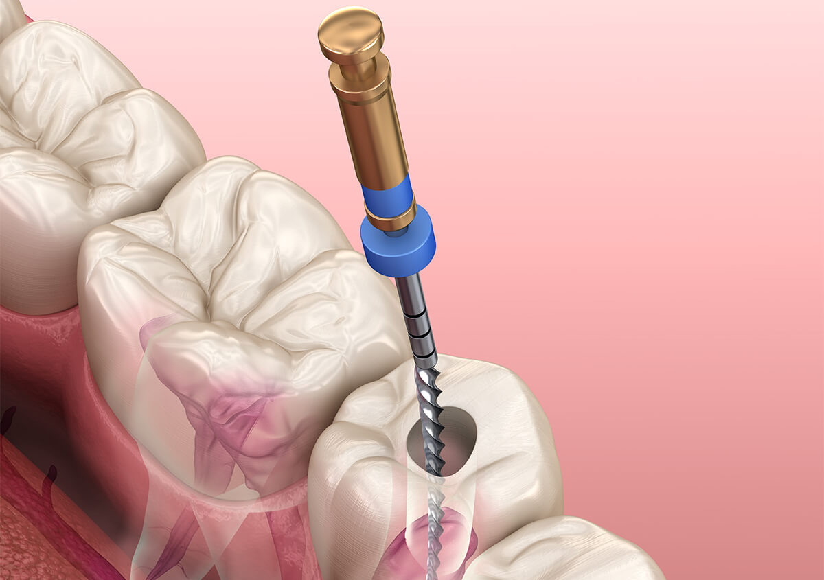 "Discover the Pain-Free Root Canal Treatment Procedure at Pathak Dental Clinic, the Best Dental Clinic in Pimpri-Chinchwad"