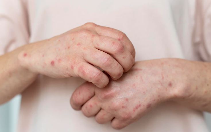 Natural Ways To Treat Allergies