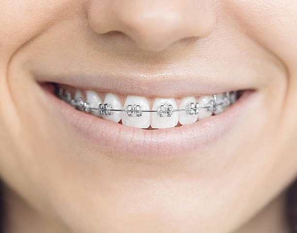 How do you get straighter teeth with braces?  