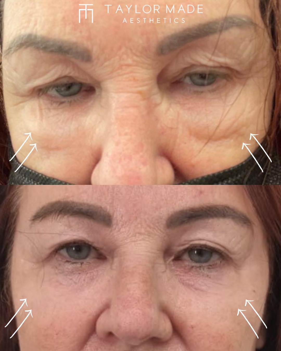 Understanding Dermal Fillers and Cheek Enhancements: Everything You Need to Know