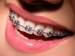 Orthodontics Syosset: Modern Braces & Invisalign Options