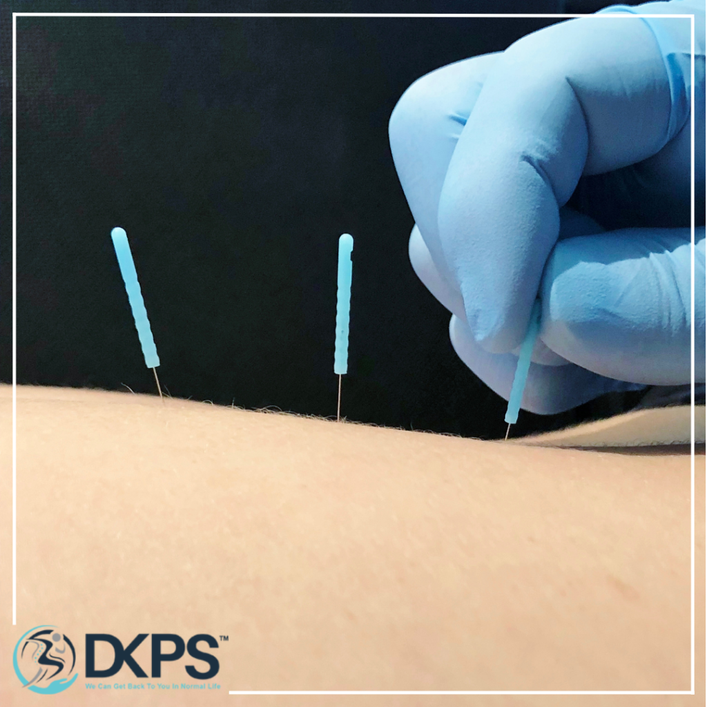 Needle Therapy For Back Pain
