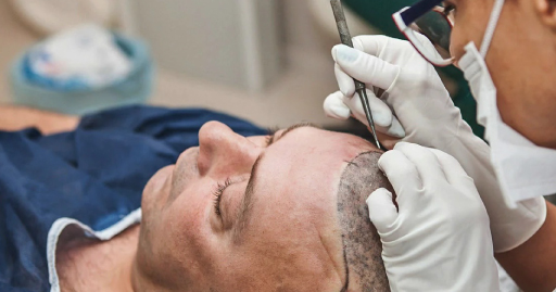 How much does Hair Transplant Cost in Delhi?