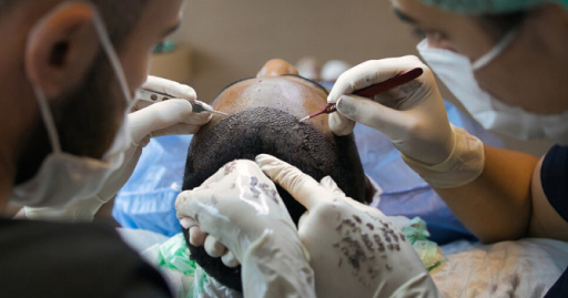 Top 5 Questions to Ask Your Hair Transplant Surgeon