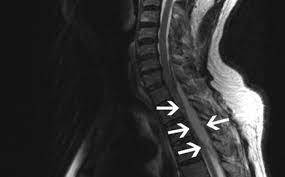 Global Epidural Abscess Treatment Market to Witness Growth by CAGR of ~9% throughout 2022 – 2030; Increasing Cases of Back and Head Surgeries to Boost the Market Growth