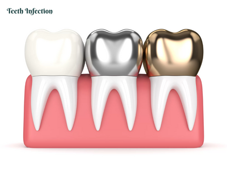 White Crowns vs Silver Crowns ?