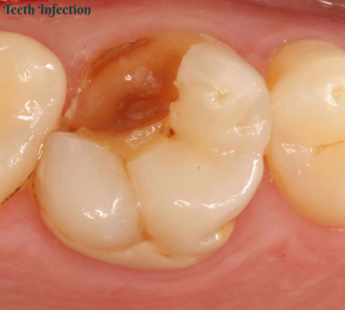 Root Canal Cracked Tooth