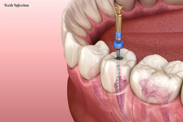 Recovery from root canal treatment