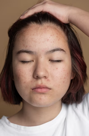 Understanding Different Types of Acne Scars: A Comprehensive Guide