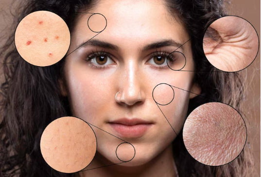 A Comprehensive Guide to Understanding Melasma: Causes, Triggers, and Treatment