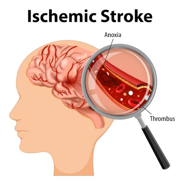 Acute Ischemic Stroke Diagnosis Market Trends, Segmentation, Overview, And Forecast Till 2032