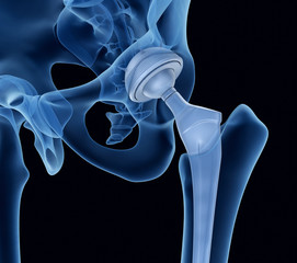 Hip Replacement Implants Industry Report Size, Share, Growth, Trends And Forecast Till 2032 