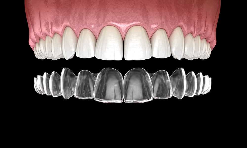 why do we select Dental Implant Cost in Chicago?