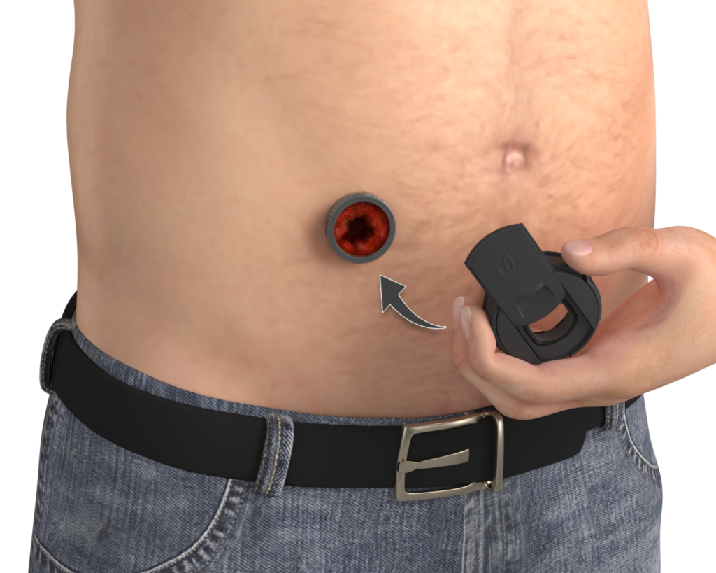 Ostomy/Stoma Care Market Current Trends, Market Challenges & Market Analysis by 2032