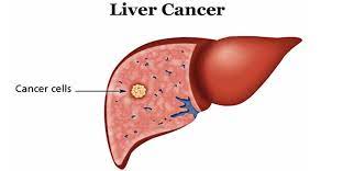 Liver Cancer Market Analysis, Advancements Outlook And Forecast 2023-2032