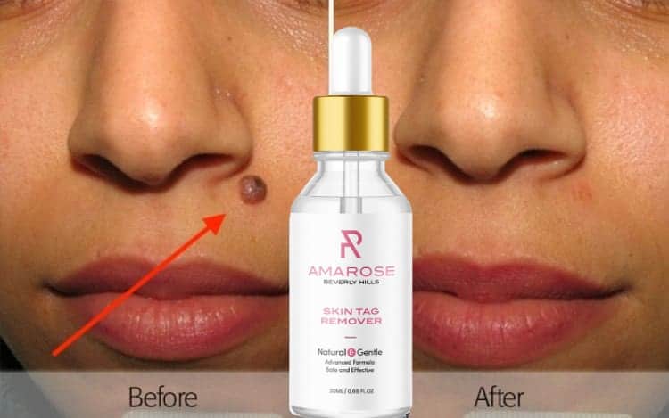 Amarose Skin Tag Remover serum famous claims 