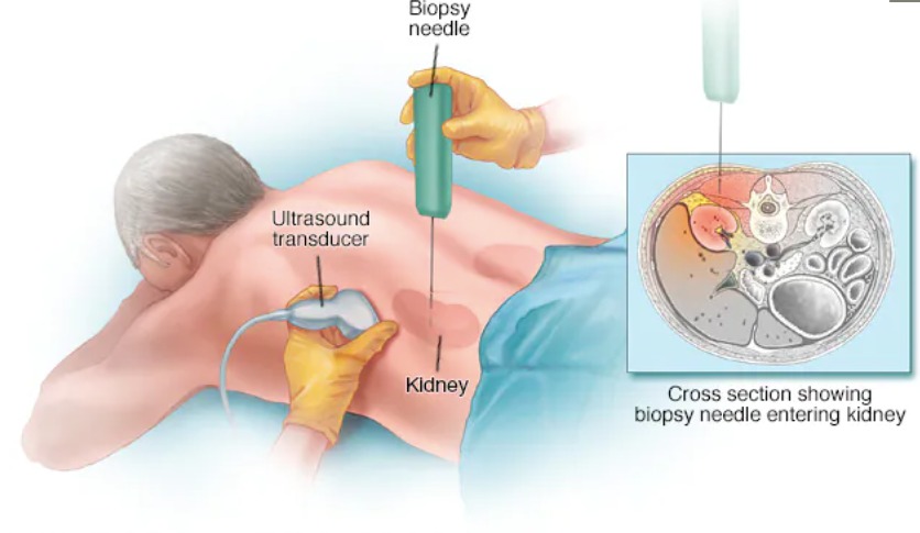 kidney biopsy