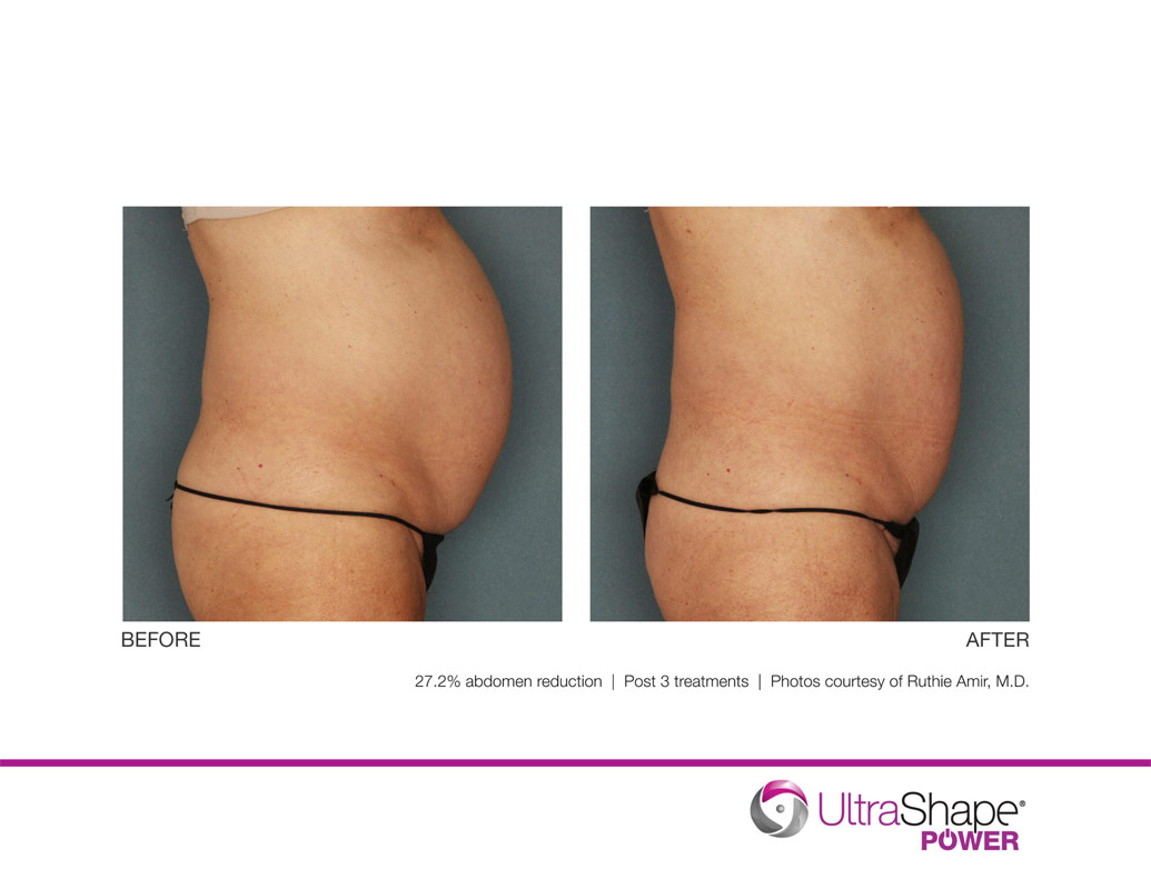 Use Ultrashape Power to Achieve Fat Destruction 