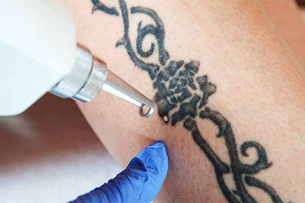 The Comprehensive Guide to Laser Tattoo Removal
