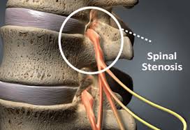 Spinal Stenosis Market Size, Share, Growth Opportunity & Global Forecast to 2028