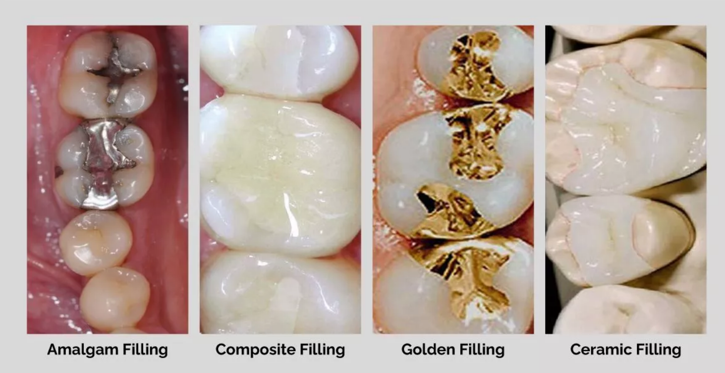 Dental Cavity Filling Material Market Size, In-depth Analysis Report and Global Forecast to 2028