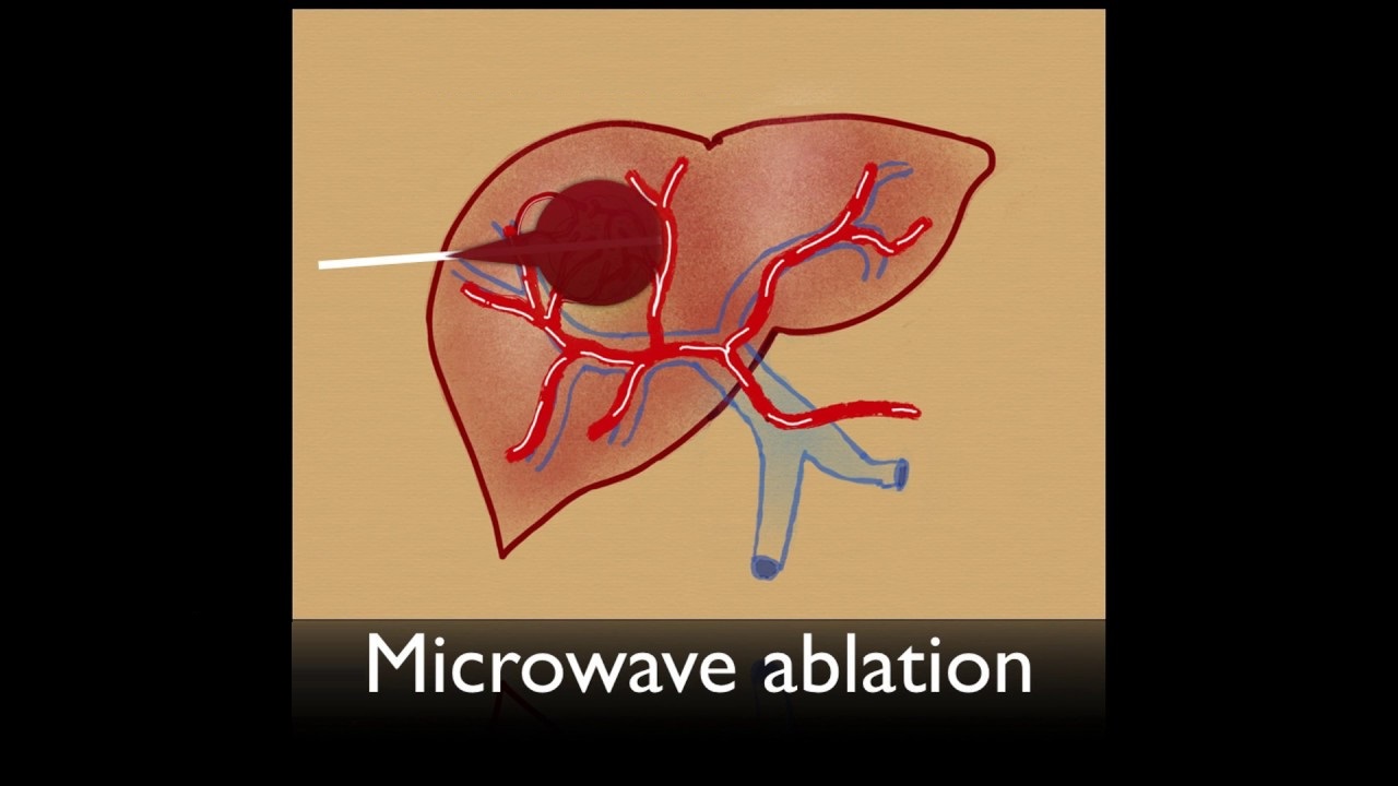 Microwave Ablation Market Size, Share, Growth, Opportunities and Global Forecast to 2030