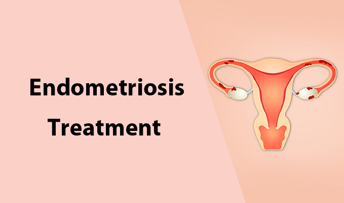 Endometriosis Treatment Market Size, Share, Growth, Opportunities and Global Forecast to 2028
