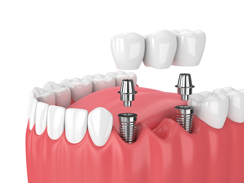 Dental Healing Caps Market Size, Share, Regional Overview and Global Forecast to 2028